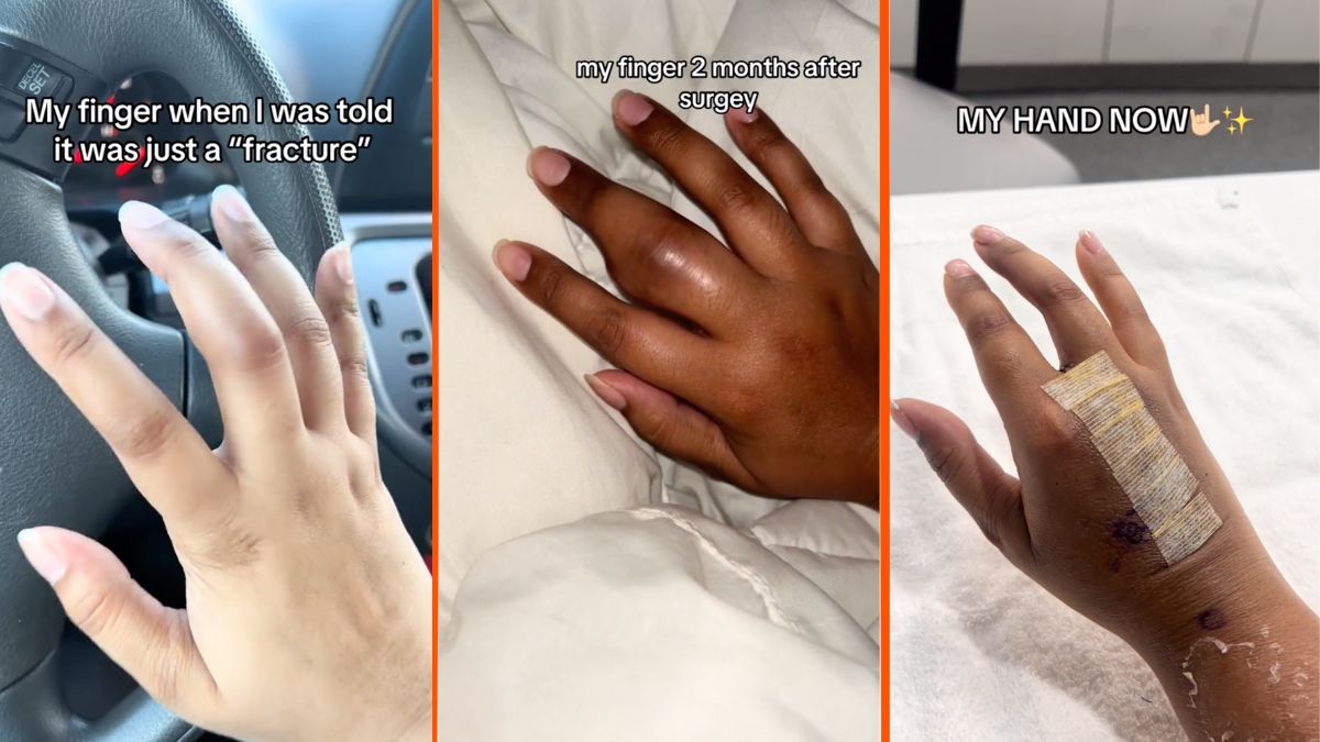 Viral TikTok misdiagnosed finger hairline fracture